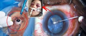 रियायती दर पर मोतियाबिंद (Cataract) ऑपरेशन – पूरी जानकारी 5 IMG 20260326 WA0008